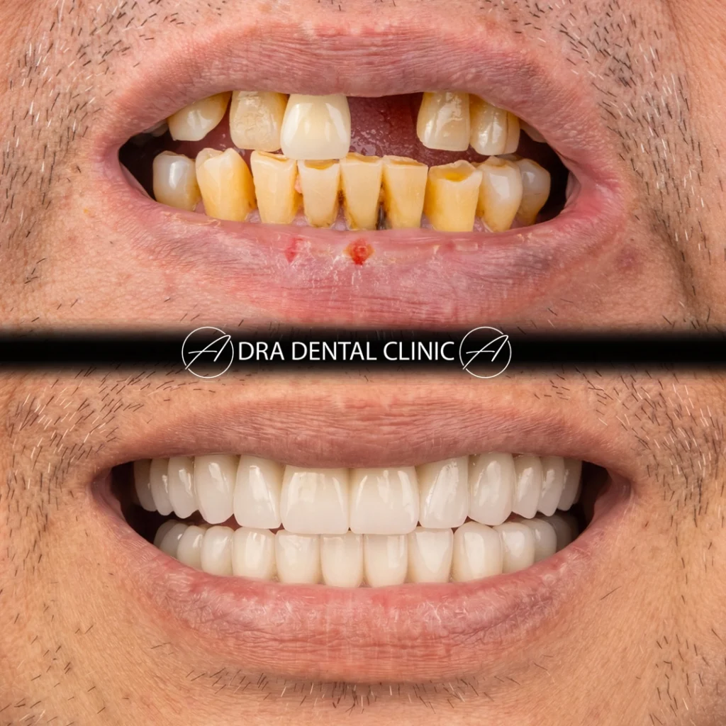 All-on-6 before and after showing missing and failing teeth replaced with a fixed implant bridge