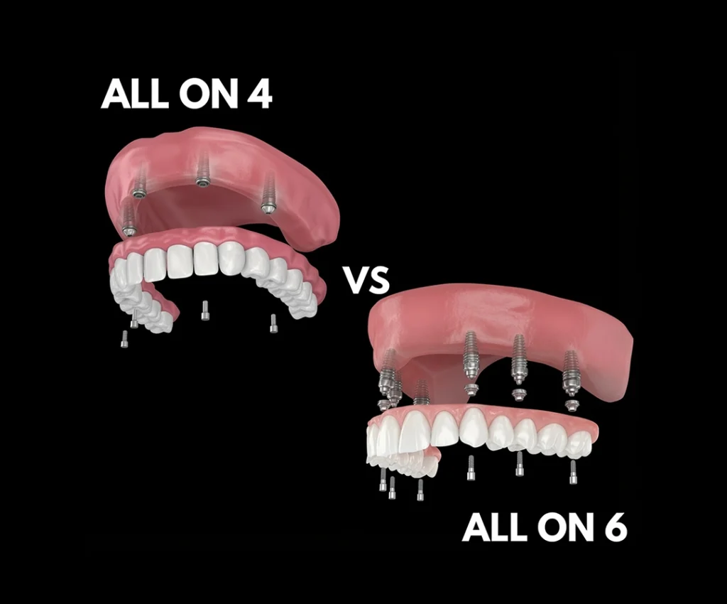 All-on-6 vs All-on-4 Dental Implants in Turkey: Which Is Right for You?