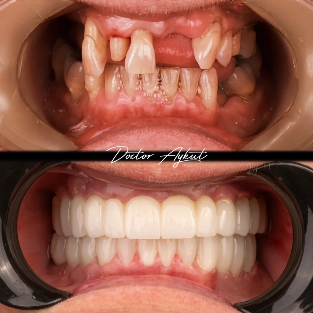 All-on-6 dental implant patient result at DRA Dental Clinic