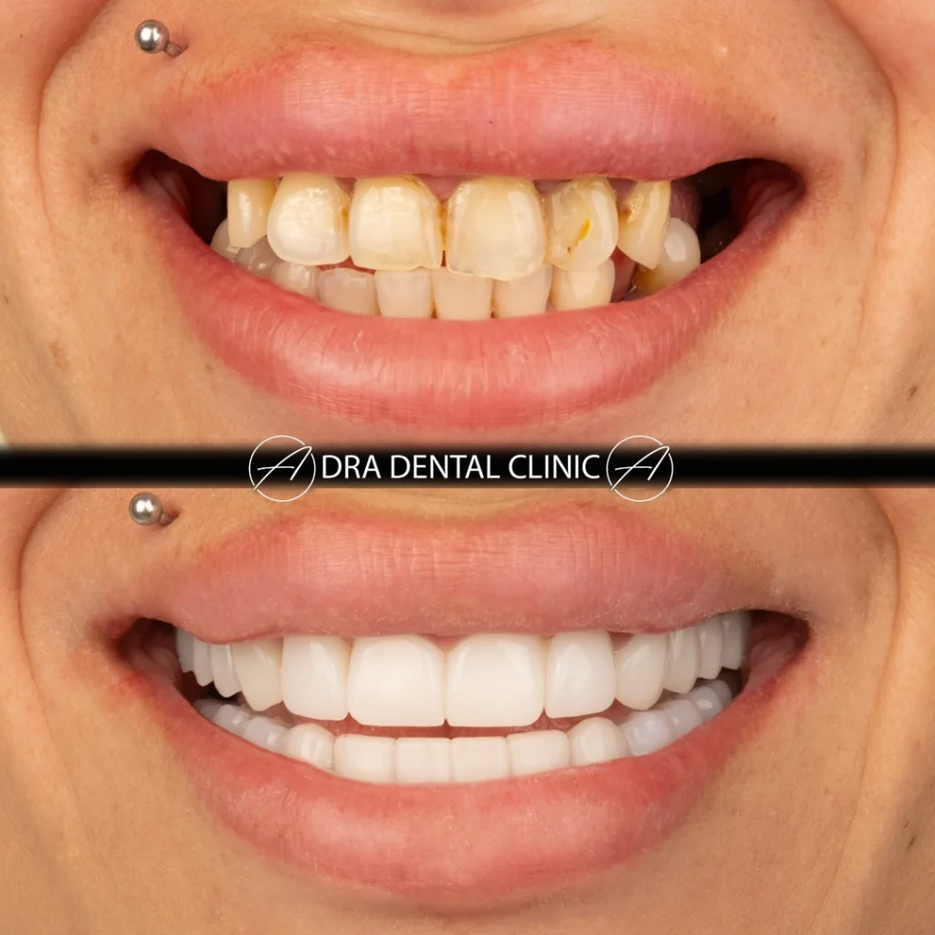 Before and after smile makeover results Turkey