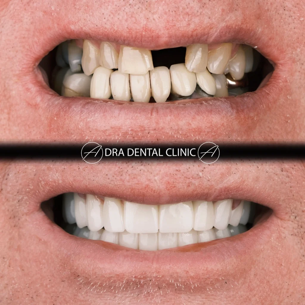 Before and after comparison of a worn-out lower jaw restored with an All-on-6 implant bridge