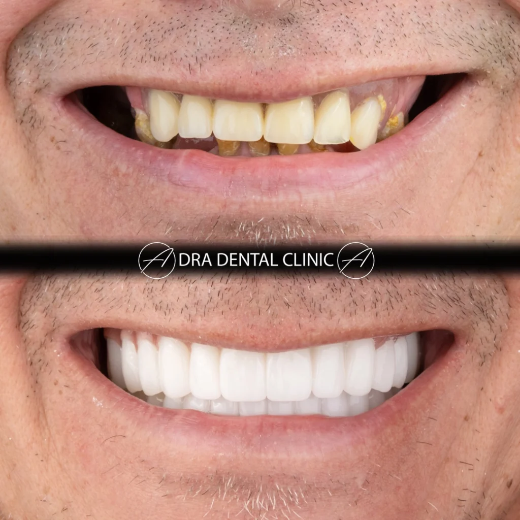Before and after of an upper arch rebuilt with All-on-6 implants after multiple tooth loss