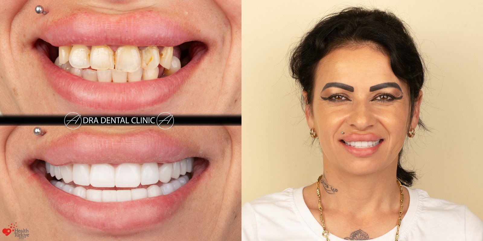 Before and after Smile Design and Dental Bridge case at DRA Dental Clinic, Turkey