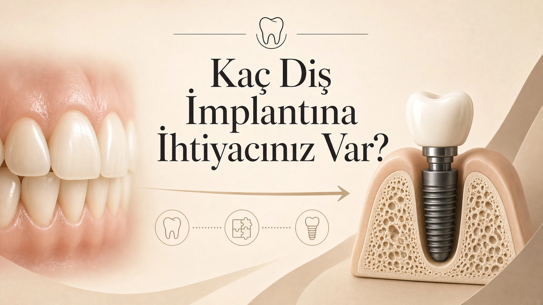 Kaç diş implantına ihtiyaç olduğunu anlatan kapak görseli
