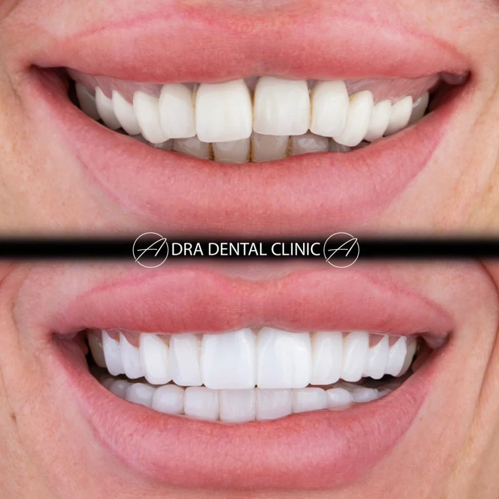 Female patient smiling after smile design treatment at DRA Dental Clinic in Antalya, Turkey