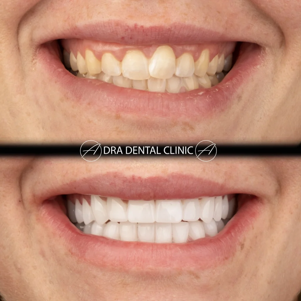 Before and after of a digitally planned smile design correcting uneven tooth edges and shade