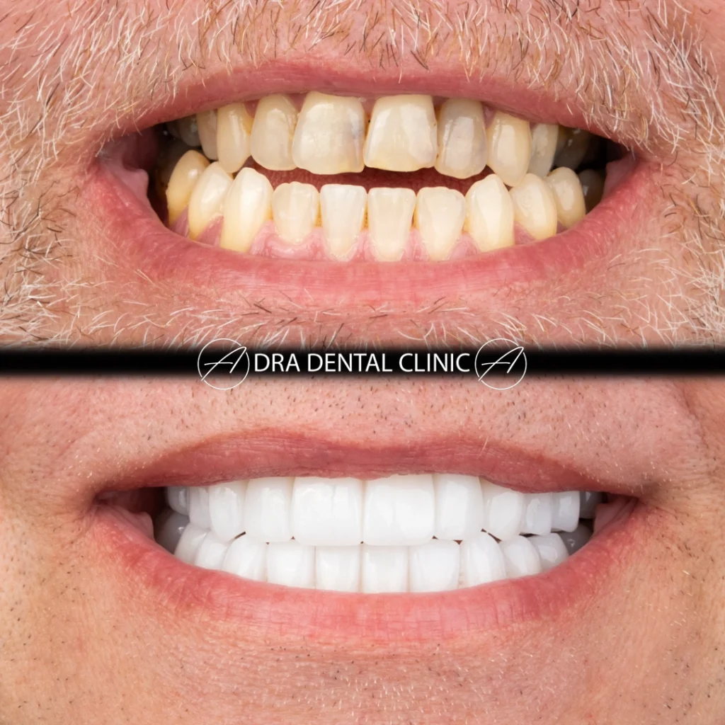 Before and after a smile makeover showing crowded, stained teeth reshaped into an even white smile