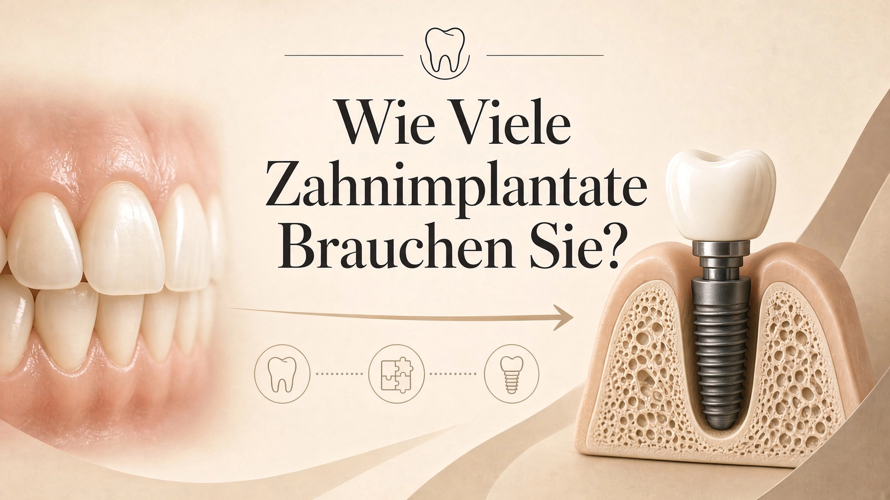 Wie viele Zahnimplantate brauchen Sie?