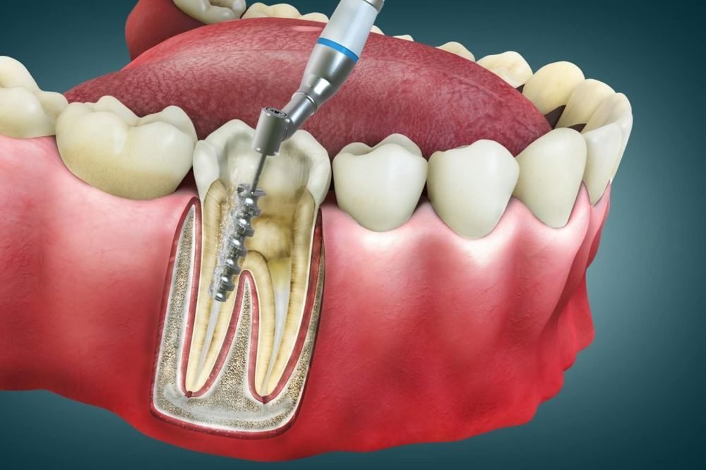 Root-Canal-1024x683-1_1000x666